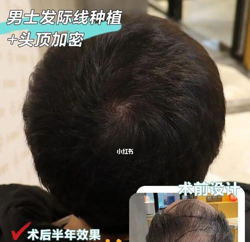 17岁头发稀疏恢复方法（年轻人头发稀疏问题解决方案）
