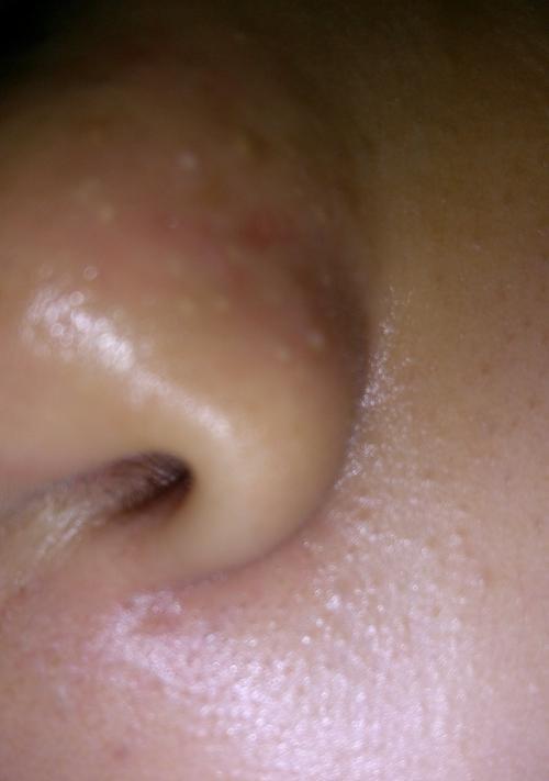 告别鼻上黑头，轻松拥有清爽肌肤（鼻上黑头去除的小妙招）