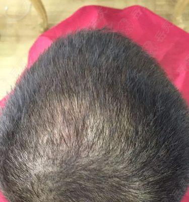 一直掉头发很厉害怎么办？有效预防和治疗脱发的方法有哪些？