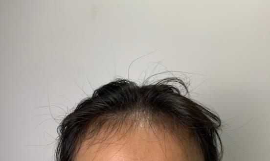 产后严重脱发怎么办呢？有效解决方法有哪些？