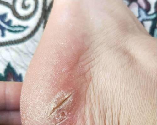 女人脚后跟干裂起硬皮怎么办？有效解决方法有哪些？