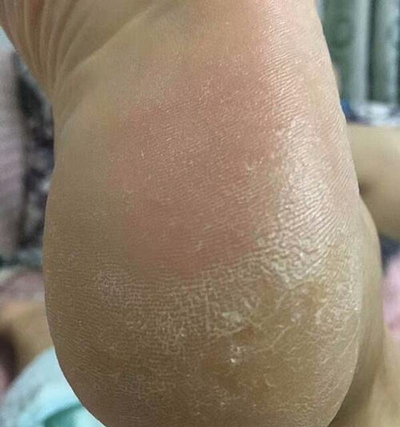 女人脚后跟干裂起硬皮怎么办？有效解决方法有哪些？