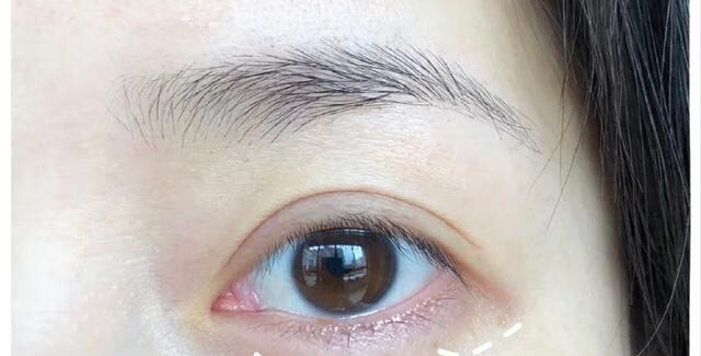鱼尾纹怎么治疗最有效？哪种方法效果最好？
