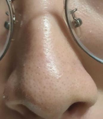 牙膏去黑头有效吗？正确使用方法是什么？