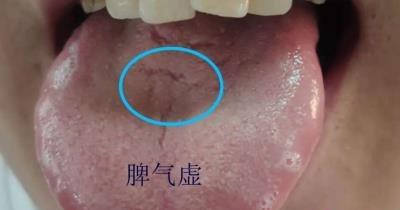 舌裂纹是怎么回事？可能的原因和解决方法是什么？
