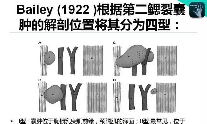 腮裂囊肿手术后多久能恢复游泳？
